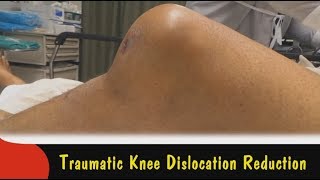 Traumatic Knee Dislocation Reduction [upl. by Danelle]