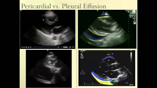 Pericardial Effusion Ultrasound Review [upl. by Adnor794]