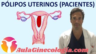 PÓLIPOS UTERINOS PACIENTES Síntomas diagnóstico y tratamiento  Ginecología y Obstetricia [upl. by Atisor418]