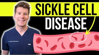 Doctor explains SICKLE CELL DISEASE  Causes symptoms and treatment [upl. by Ramso151]