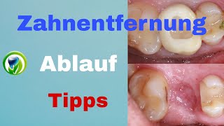 Zahnentfernung  Zahnextraktion  Zahn muss raus  Schritt für Schritt Anleitung praktische Tipps [upl. by Bobbye205]