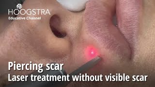 Piercing scar  Laser treatment without visible scar  24094 [upl. by Phia306]