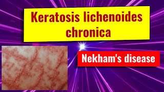 Keratosis lichenoides chronica overview causes features management [upl. by Sire]