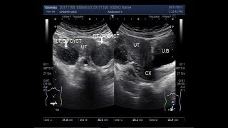 Difference Between Ovarian cyst and Adnexal Cyst [upl. by Harbison813]