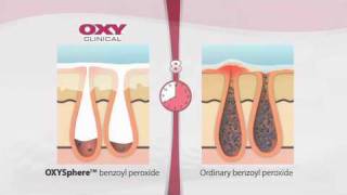 How OXY Clinical Actives Work To Fight Acne [upl. by Schluter]