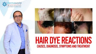 Hair dye reactions  Causes Diagnosis Symptoms and Treatment [upl. by Bushey422]