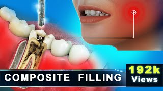 Composite Filling  Molar Cavity Filling with Composite  Advance 3D Dental Animation [upl. by Murtha]