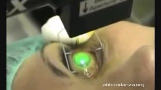 Corneal Collagen Crosslinking for keratoconus  Dr Marco Abbondanza [upl. by Crista]