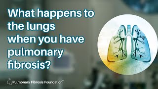 How Pulmonary Fibrosis Affects the Lungs [upl. by Cobb]