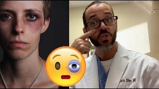 Black Eye  Patient Education Video  Dr Carlo Oller [upl. by Lanevuj]