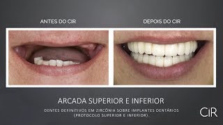 Antes e Depois  Implante Dentário Protocolo [upl. by Aivitnahs954]