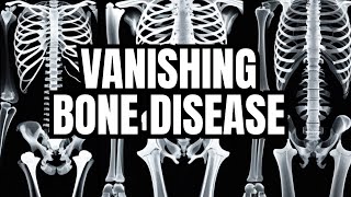 GorhamStout disease vanishing bone disease disappearing bone disease phantom bone disease [upl. by Thorley830]