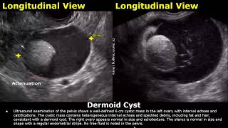 Ovary Ultrasound Reporting  Ovarian Diseases Scan Reports  How To Write USG Report  Pelvic USG [upl. by Paulson766]