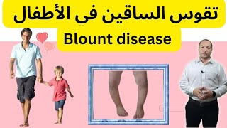 تقوس الساقين في الأطفالمرض بلاونتgenu varum  blount disease [upl. by Willtrude]