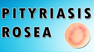 Pityriasis Rosea Symptoms Treatment and Causes [upl. by Routh872]