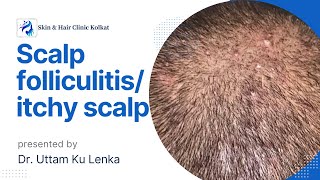 Scalp Folliculitis Treatment सर मैं दाना का इलाज Dr Uttam Kumar Lenka Consultant Dermatologist [upl. by Merell]