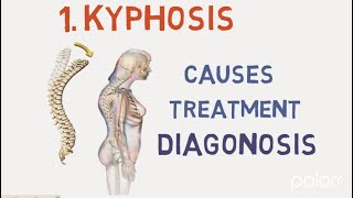 Kyphosis  Overview Causes Symptoms Treatment Diagnosis And Prevention  All in 2 min [upl. by Trudie]