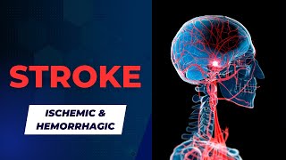 Understanding Transient Ischemic Attack TIA or MiniStroke [upl. by Anum]