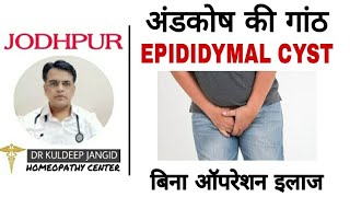 Treatment of epididymal cyst without surgery by homoeopathy । अंडकोष की गांठ का बिना ऑपरेशन इलाज । [upl. by Urbannal]