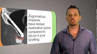 What are Zygomatic Implants AKA Zygoma  Cheekbone Implants  CAID Australia [upl. by Aineval530]