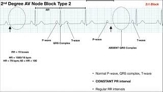 EKG Patterns  1st amp 2nd Degree AV Node Blocks [upl. by Parrott]