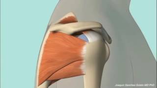 Chronic Subacromial Impingement Animation [upl. by Eannyl]