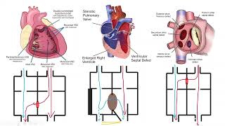 Infective Endocarditis in Pediatrics 8 [upl. by Ymmak]