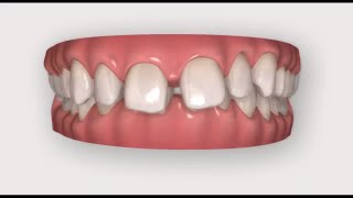 Invisalign Prima e Dopo  Morso Profondo e Diastemi  Bologna [upl. by Gershon]