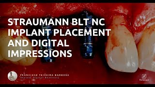 Straumann BLT Implant Placement and Digital Impressions [upl. by Bohi]