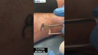 Effective Tattoo Removal Solutions at BodyClinix Say Goodbye to Regrets [upl. by Odrarebe6]