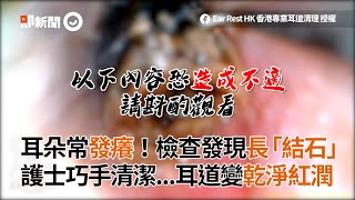 耳朵常發癢檢查發現長「結石」 護士巧手清潔耳道變乾淨紅潤｜耳結石｜清耳垢 [upl. by Nador]