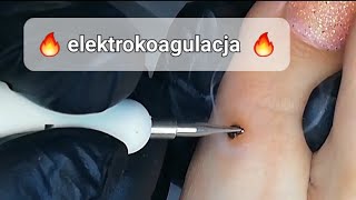 elektrokoagulacja brodawki na paluchu podologia podopogptowie elektrokoagulacja [upl. by Rehpitsirhc399]