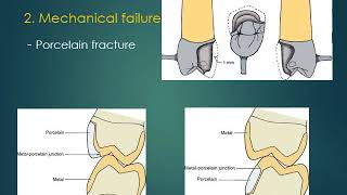 Crown and bridge Failures and Repairs [upl. by Haraf]