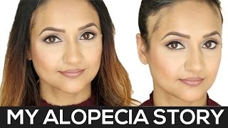 My Alopecia Story  Alopecia Areata [upl. by Favin]