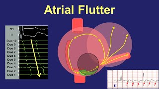 Atrial Flutter  Fundamentals of Diagnosis and Ablation [upl. by Wolfgram]