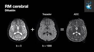 RM Cerebral Parte 1 Secuencias básicas [upl. by Ahseetal]