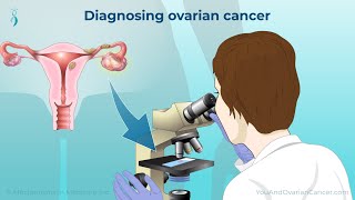 5 Warning Signs and Risk Factors of Ovarian Cancer [upl. by Norvan660]