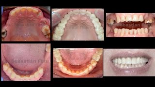 Lucrare dentara  coroane dentare ZIRCONIU  Implant dentar [upl. by Dorthy]