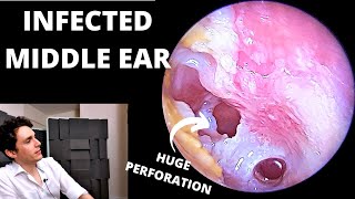 The Worst Ear Infection Suppurative Otitis Media [upl. by Stoneman]