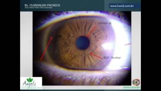 🔴Webinário ao vivo  Bronquiectasia pulmonar [upl. by Healion382]