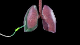 Hemotorax Drenaje Pleural [upl. by Ahcila]