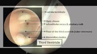 Endoscopic Ventriculostomy of the Third Ventricle [upl. by Plunkett]