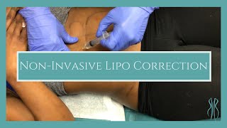 NonInvasive Lipo Correction [upl. by Robbin]