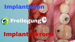 Zahnimplantation Freilegung Abformung Implantatkrone  Ablauf  Zeitraum  Dauer  Termine [upl. by Gnoix]