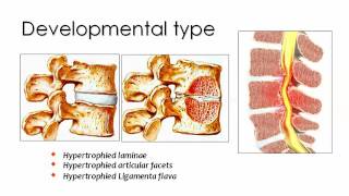 Spinal degenerative diseases Imaging Prof Dr Mamdouh Mahfouz 720p [upl. by Ietta616]