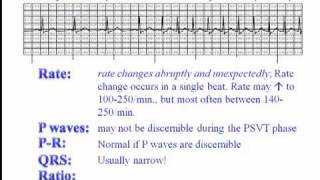 ECG Paroxysmal Supraventricular Tachycardia PSVT [upl. by Teryn]