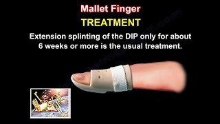 Mallet Finger Treatment  Everything You Need To Know  Dr Nabil Ebraheim [upl. by Lavud]