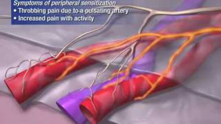 Migraines  Pathophysiology amp Treatment Described Concisely [upl. by Atneuqal343]