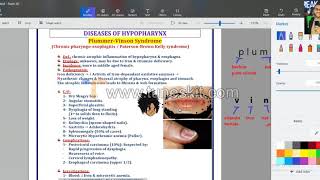 ENT  Plummer vinson amp pharyngeal pouch [upl. by Lucienne]