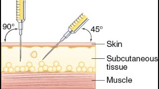 Subcutaneous Injection Demonstration [upl. by Eisdnil]